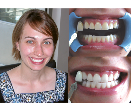 Beyond Polus Whitening Accelerator - мультифункциональная комплексная система для профессионального отбеливания зубов фото 4