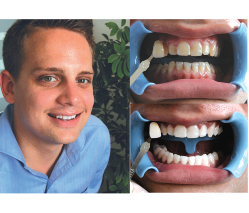 Beyond Polus Whitening Accelerator - мультифункциональная комплексная система для профессионального отбеливания зубов фото 2