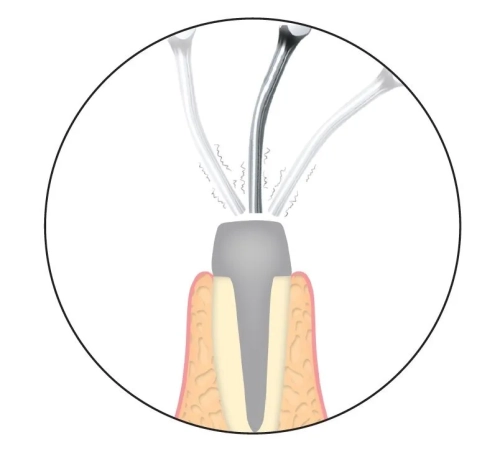 Насадка G25 для скалера NSK®/Satelec® фото 2
