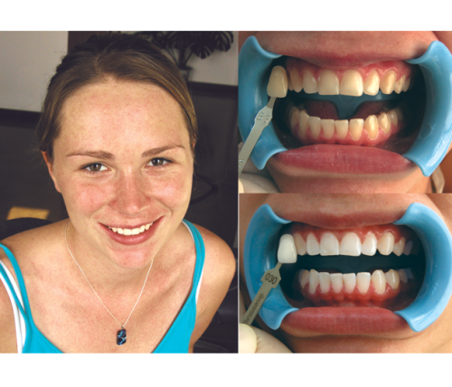 Beyond Polus Whitening Accelerator - мультифункциональная комплексная система для профессионального отбеливания зубов фото 5
