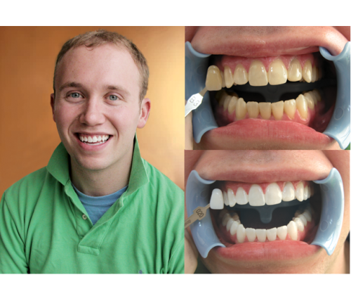Beyond Polus Whitening Accelerator - мультифункциональная комплексная система для профессионального отбеливания зубов фото 3